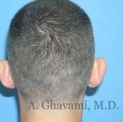 Otoplasty Before & After Patient #7371