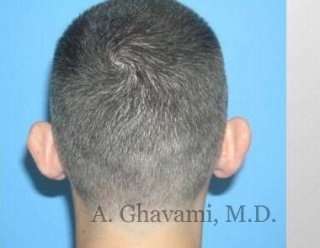 Otoplasty Before & After Patient #7371