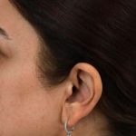 Rhinoplasty Before & After Patient #7357