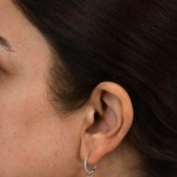 Rhinoplasty Before & After Patient #7357