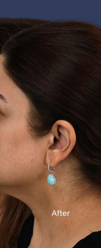 Rhinoplasty Before & After Patient #7357