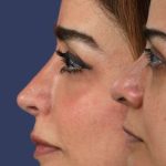 Rhinoplasty Before & After Patient #7357
