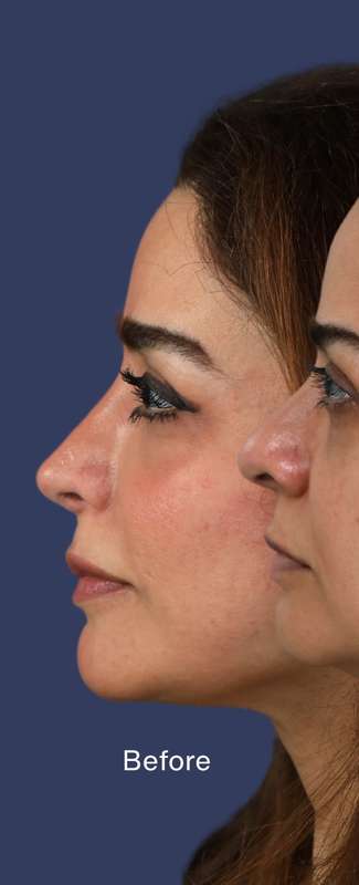 Rhinoplasty Before & After Patient #7357