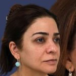 Rhinoplasty Before & After Patient #7357