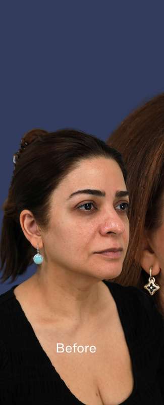 Rhinoplasty Before & After Patient #7357