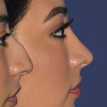 Ethnic Rhinoplasty Before & After Patient #7349