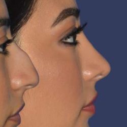 Ethnic Rhinoplasty Before & After Patient #7349