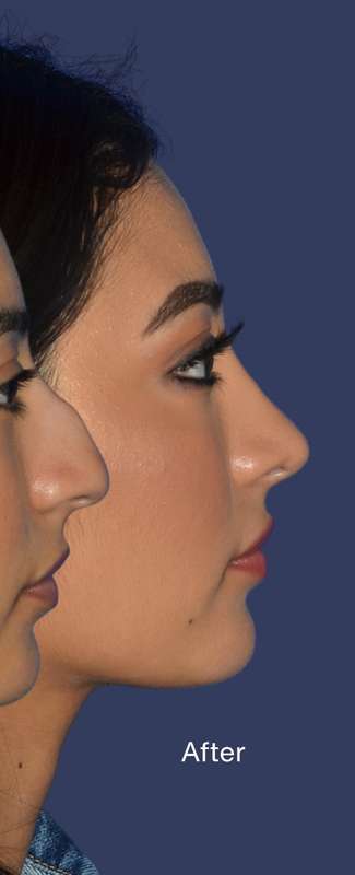 Ethnic Rhinoplasty Before & After Patient #7349