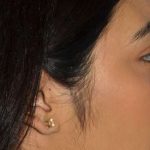 Ethnic Rhinoplasty Before & After Patient #7349