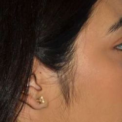 Ethnic Rhinoplasty Before & After Patient #7349