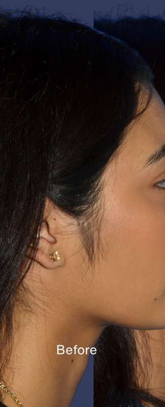 Ethnic Rhinoplasty Before & After Patient #7349