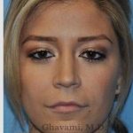 Rhinoplasty Before & After Patient #7329