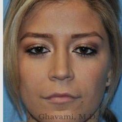 Rhinoplasty Before & After Patient #7329