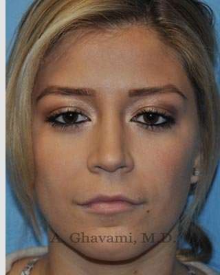 Rhinoplasty Before & After Patient #7329