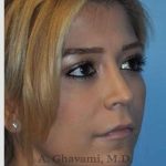 Rhinoplasty Before & After Patient #7329