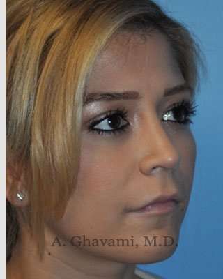 Rhinoplasty Before & After Patient #7329