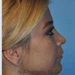 Rhinoplasty Before & After Patient #7329