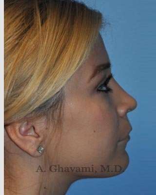 Rhinoplasty Before & After Patient #7329
