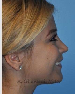 Rhinoplasty Before & After Patient #7329