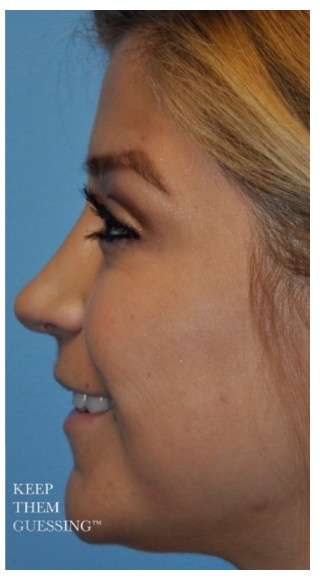 Rhinoplasty Before & After Patient #7329
