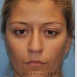 Rhinoplasty Before & After Patient #7329