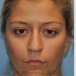 Rhinoplasty Before & After Patient #7329