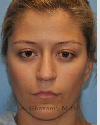 Rhinoplasty Before & After Patient #7329