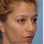 Rhinoplasty Before & After Patient #7329