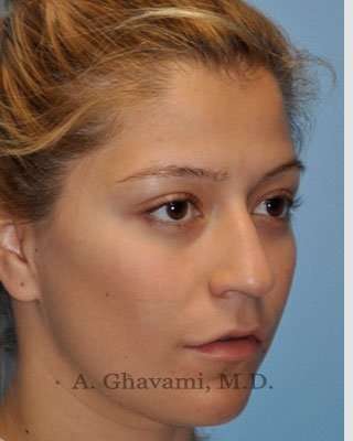 Rhinoplasty Before & After Patient #7329