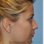 Rhinoplasty Before & After Patient #7329