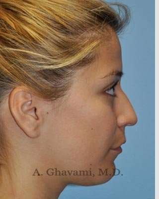 Rhinoplasty Before & After Patient #7329
