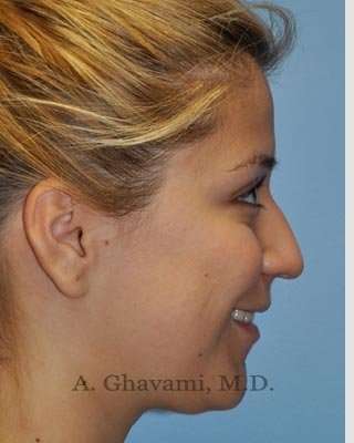 Rhinoplasty Before & After Patient #7329