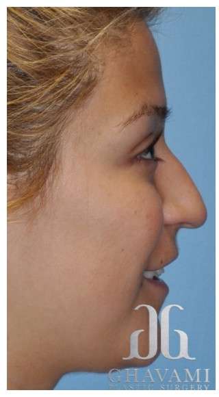 Rhinoplasty Before & After Patient #7329