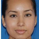 Ethnic Rhinoplasty Before & After Patient #7318