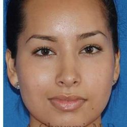 Ethnic Rhinoplasty Before & After Patient #7318