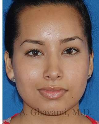 Ethnic Rhinoplasty Before & After Patient #7318