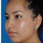 Ethnic Rhinoplasty Before & After Patient #7318