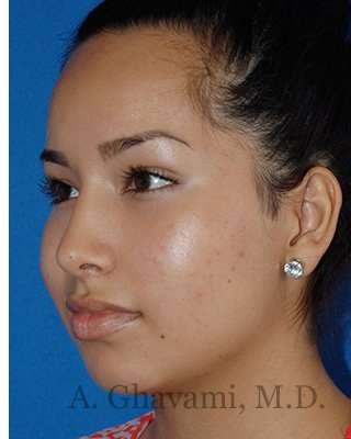 Ethnic Rhinoplasty Before & After Patient #7318