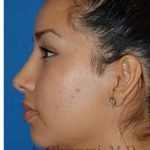 Ethnic Rhinoplasty Before & After Patient #7318