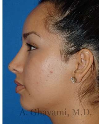 Ethnic Rhinoplasty Before & After Patient #7318