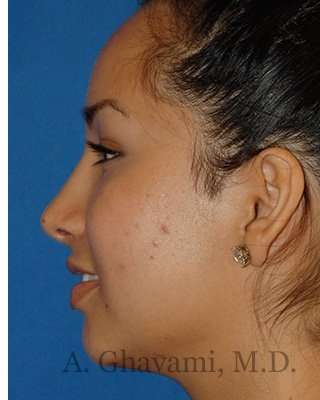 Ethnic Rhinoplasty Before & After Patient #7318