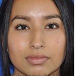 Ethnic Rhinoplasty Before & After Patient #7318