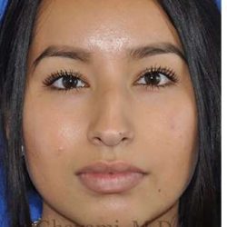 Ethnic Rhinoplasty Before & After Patient #7318