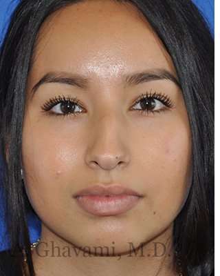 Ethnic Rhinoplasty Before & After Patient #7318
