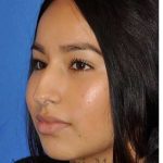 Ethnic Rhinoplasty Before & After Patient #7318