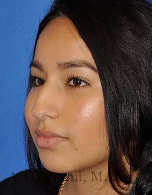 Ethnic Rhinoplasty Before & After Patient #7318