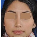Rhinoplasty Before & After Patient #7309