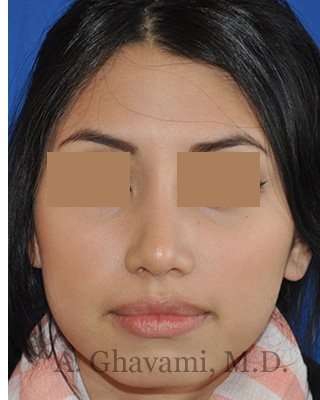 Rhinoplasty Before & After Patient #7309
