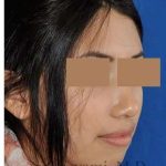 Rhinoplasty Before & After Patient #7309