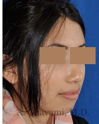 Rhinoplasty Before & After Patient #7309